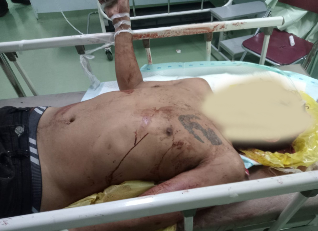 Seorang pria, diduga menjadi korban pengeroyokan, terbaring dalam kondisi kritis di atas ranjang rumah sakit. Wajah korban disamarkan, memperlihatkan tubuh bertato yang dipenuhi luka dan noda darah. Korban saat ini sedang menjalani perawatan intensif.